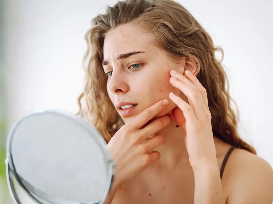 De veilige puist-aanpak van Schoonheidssalon Astrid Vervoort