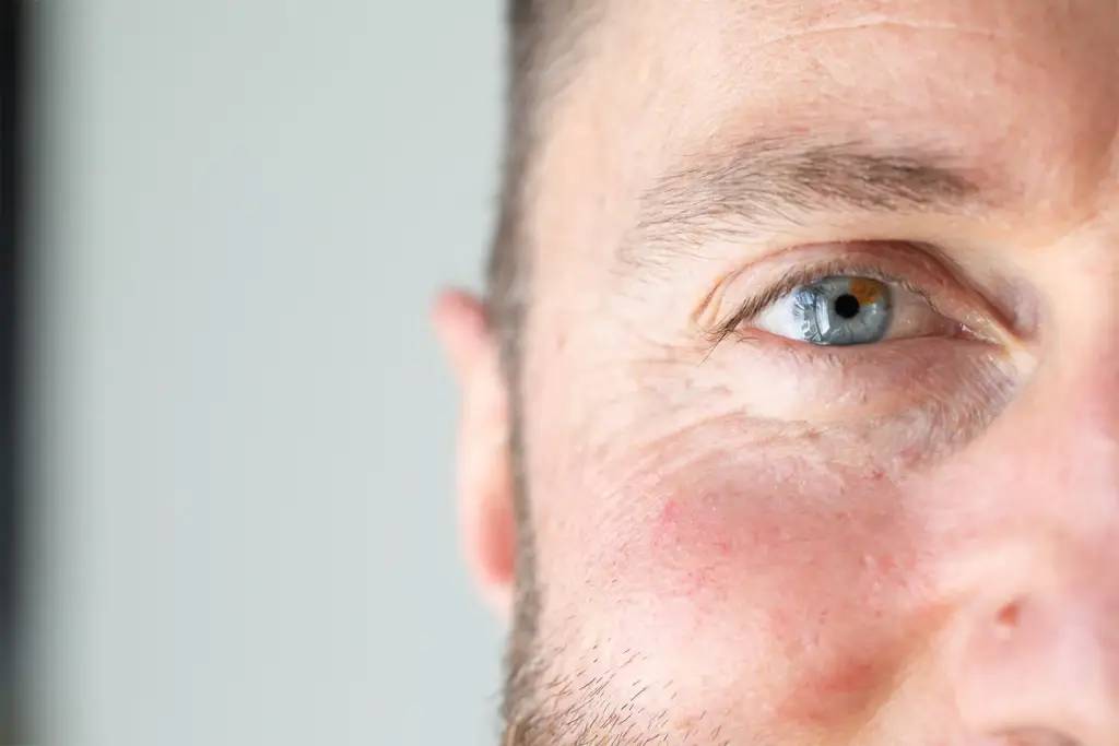 Huidaandoening rosacea | Schoonheidssalon Astrid Vervoort