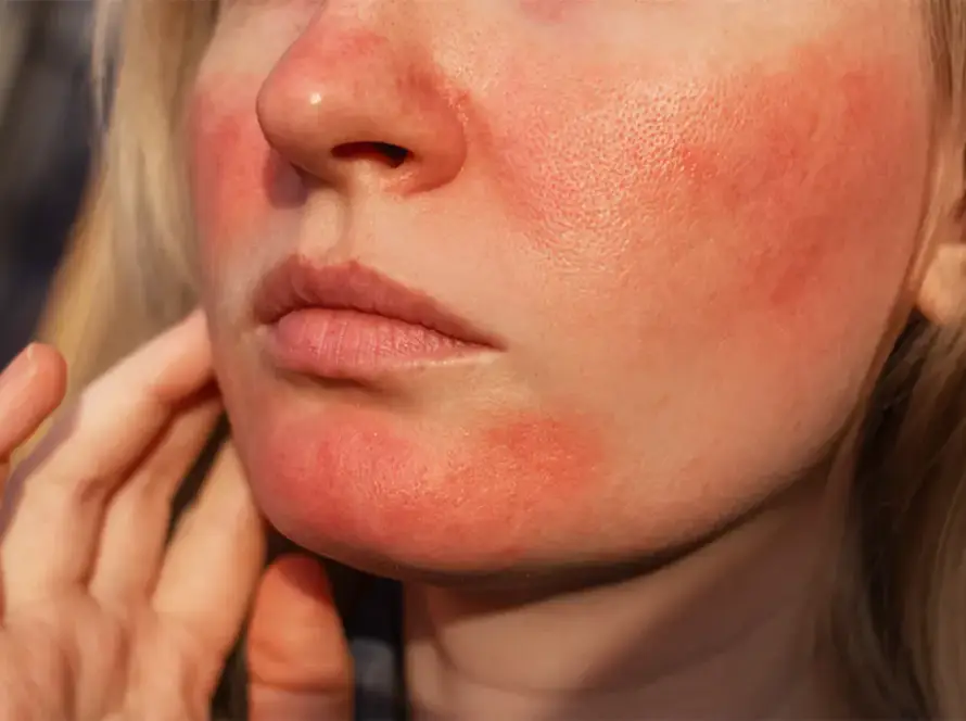 Huidaandoening rosacea en couperose | Schoonheidssalon Astrid Vervoort