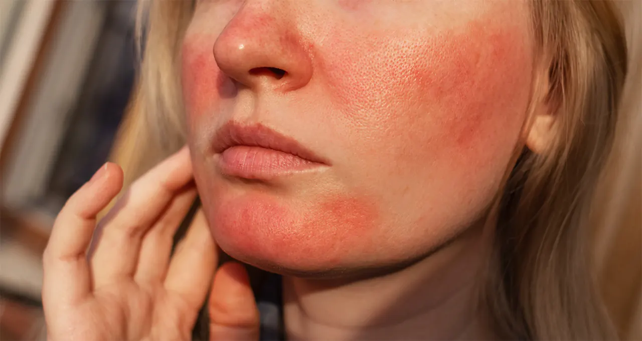 Huidaandoening rosacea en couperose | Schoonheidssalon Astrid Vervoort