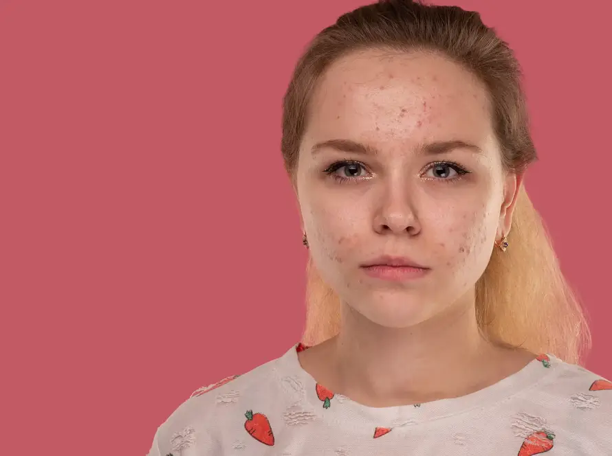 Waarom steeds meer jonge huiden overprikkeld raken | Schoonheidssalon Astrid Vervoort